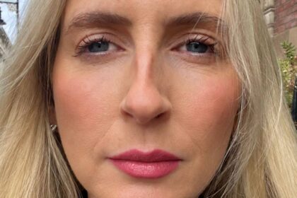 Trying lip filler for the first time at 48